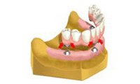 総入れ歯からのインプラント　オール・オン・フォー（All on 4）