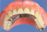 入れ歯 自費治療2